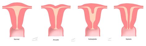 bicornuate vs arcuate uterus Success