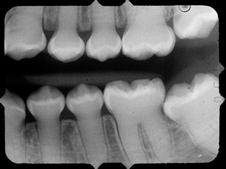 Dentinogenesis Imperfecta – Dr. G's Toothpix