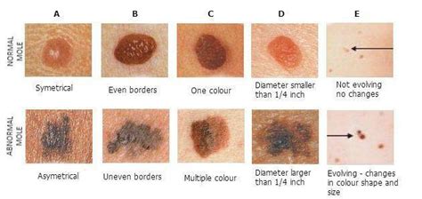 GitHub - PratikSaha198/SIIM-ISIC-Melanoma-Classification-Kaggle-Competition: My solution to ...