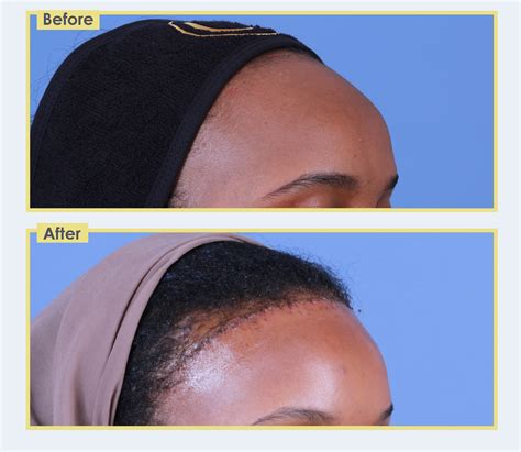 Gallery – Forehead Reduction