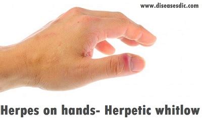 Herpetic Whitlow - Overview, Risk factors, and Diagnosis.