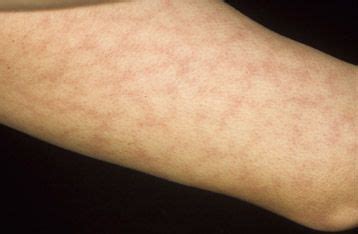 Livedo reticularis rimedi information | interrogatory