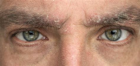 Got Eyebrow Dandruff? Here’s What Your Body’s Telling You