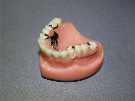 Flexible Partial Dentures