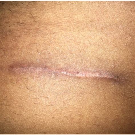 McBurney's point appendicectomy scar. | Download Scientific Diagram