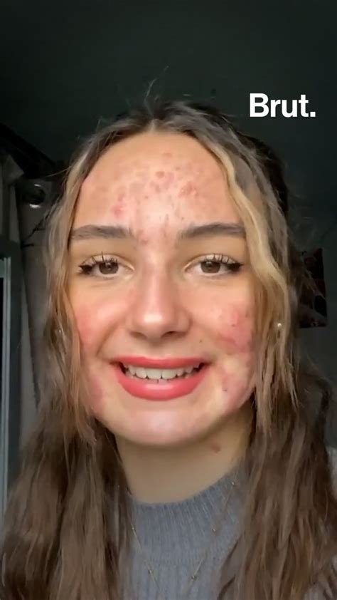 Living with severe acne: Mattéa tells her story | Brut.