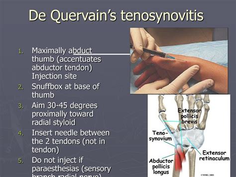 PPT - Steroid Joint injections PowerPoint Presentation, free download ...