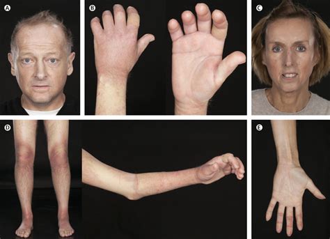 Systemic Scleroderma Hands