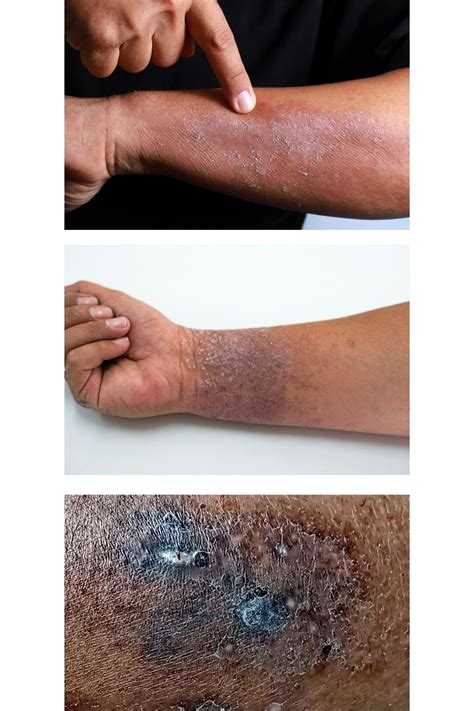 Atopic Eczema On Black Skin