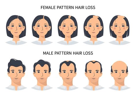 Hair loss stages, androgenetic alopecia male and female pattern. Steps ...