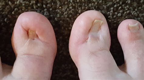 Ingrown Toenail: The Ugliest Toes in the World – Gloopa.co.uk