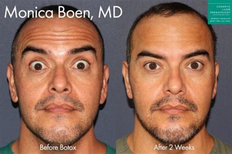 Most Common Side Effects of Botox - Cosmetic Laser Dermatology Skin Specialists in San Diego