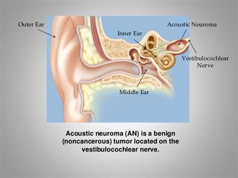 What is acoustic neuroma?