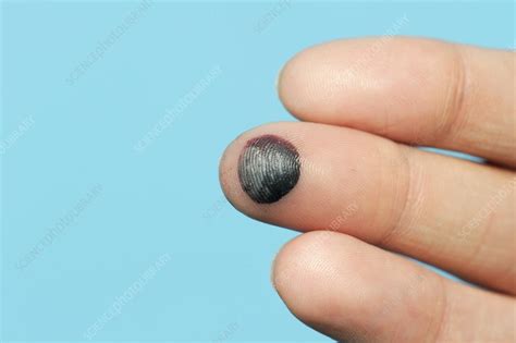 Blood blister on the finger - Stock Image - C010/3248 - Science Photo Library