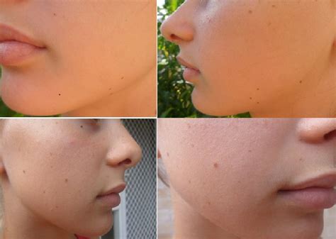 The Science of Beauty: The acne series: a teen's perspective of the Teen Aspect Kit