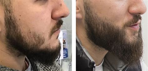 How To Fix Beard Bald Spots | Wimpole Clinic