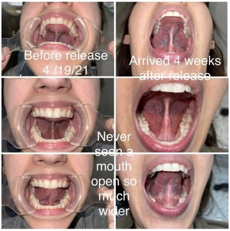 Tongue-Tie and Lip-Tie in Adults | Dentist in Arlington, VA
