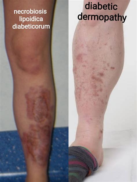 Necrobiosis Lipoidica Diabeticorum