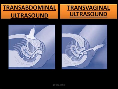 Transvaginal ultrasound presentation by Dr. Taila Amber