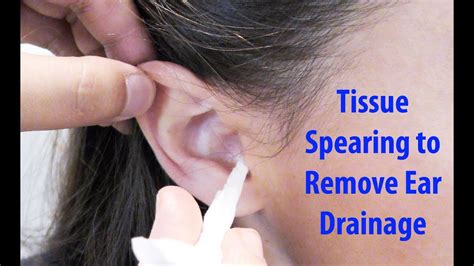 Tissue Spears to Remove Ear Drainage - YouTube