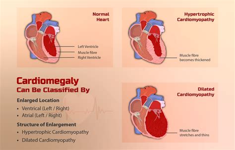 What Is Familial Hypertrophic Cardiomyopathy? - StoryMD