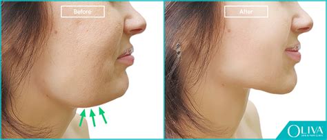 Non-Surgical Double Chin Treatment: Benefits, Cost And Results