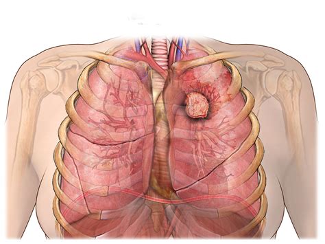 Lung Carcinoid Tumors Facts | City of Hope | California