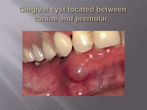 Odontogenic cysts