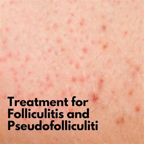 Treatment for Folliculitis and Pseudofolliculitis | Depilcompany News blog