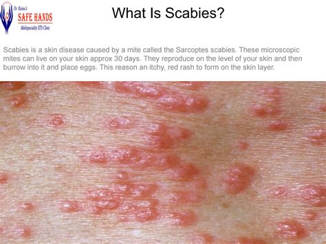 Get effective treatment for scabies by safehandsclinic - Issuu