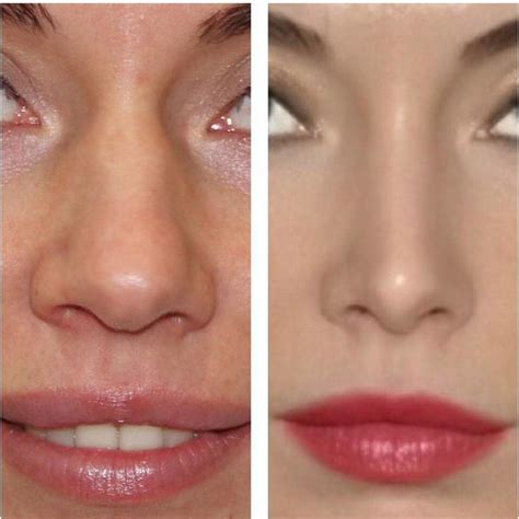 Rhinoplasty Bulbous Nose Reduction Is One Of The Most Commonly ...