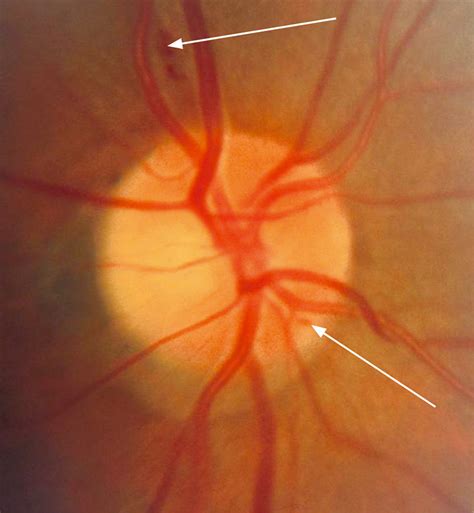 Community Eye Health Journal » The optic nerve head in glaucoma