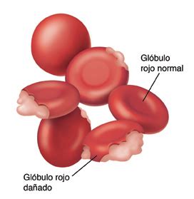 Anemia Hemolitica Conceito Causas Sintomas Diagnostico E Tratamento Images