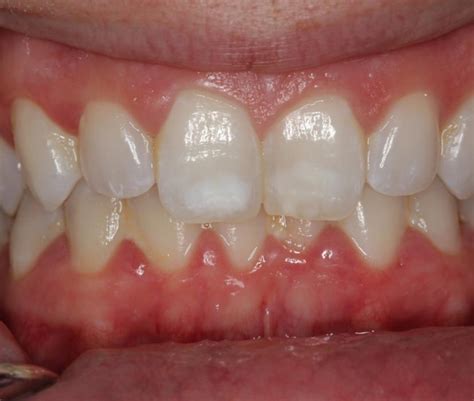 Sunshine Smiles of Orange County Blog | How To Get Rid Of White Spots On Your Front Teeth Easily ...