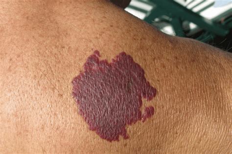 Port Wine Stain Treatment Scottsdale | Birthmark Removal