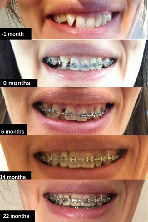 Braces at 30 | 14th Tightening | 22 Months | Before and After Photos in ...