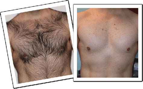 men-hair-chest-before-after - आयुर्वेद हीलिंग