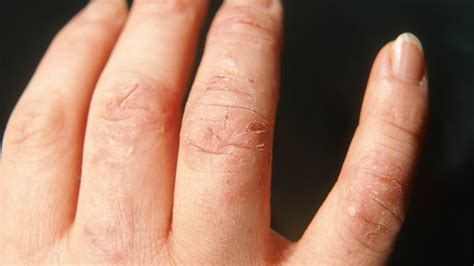Mild Dyshidrotic Eczema Fingers