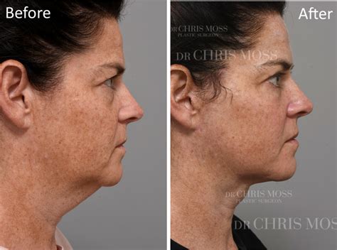 Facelift & Neck Lift Results - Before and After