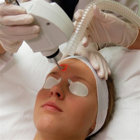 Does Laser Treatment for Acne Work?