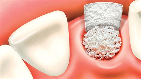 OC Maxillofacial Surgery: Dental Bone Grafts - What They Are and Why We Need Them