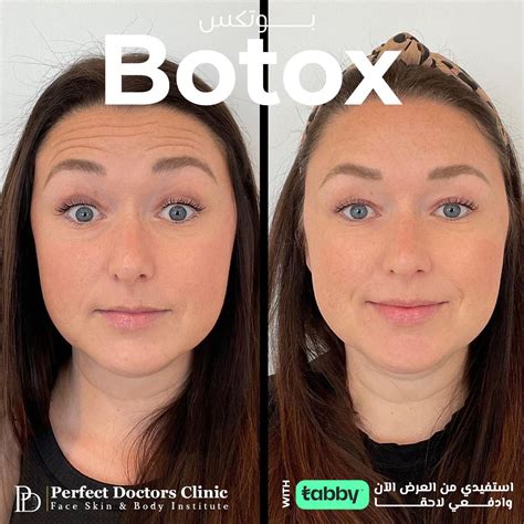 Botox Injections Treatments in Dubai Abu Dhabi - Best Botox Clinic Offer in Dubai Abu Dhabi