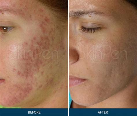 Microneedling Therapy for Acne Scars in The Woodlands - Blog