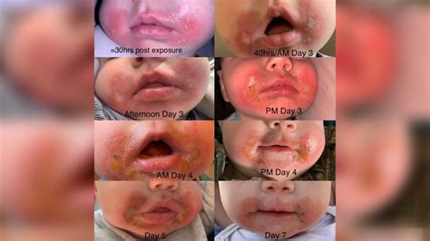 Baby develops severe ‘burn-like’ rash after eating a piece of celery in the sun | The Cairns Post