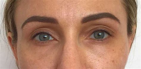 Los Angeles Non-Surgical Eye Lift | Santa Monica Eyelid Lift, Blepharoplasty