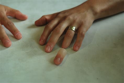 Finger prosthesis for amputee