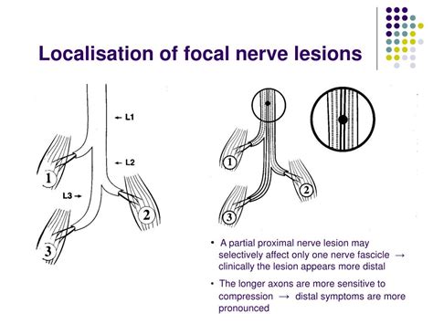 PPT - Polyneuropathies Mononeuropathies Motoneuron diseases PowerPoint Presentation - ID:3337545