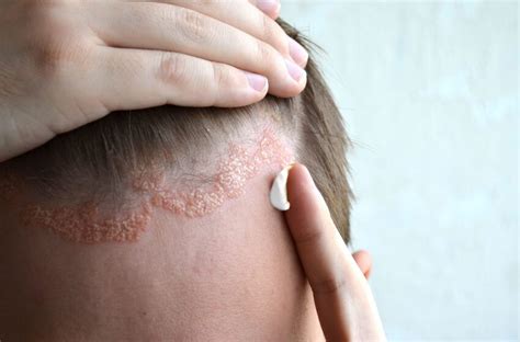 DERMATITIS SEBORREICA – Med Enfermería