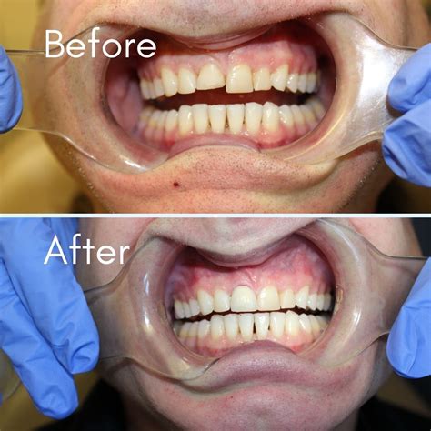 Mothlhtqqjbpqdp: Front Tooth Filling Before And After