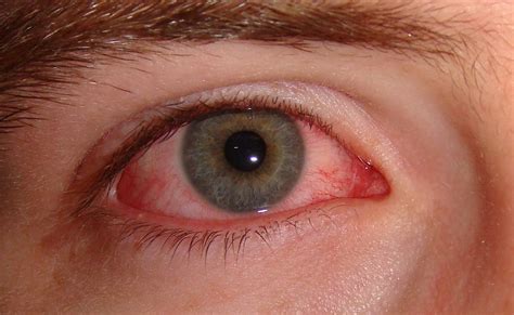 The Many Causes of a Red Eye | Wilmington Family Eye Care